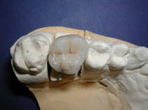 porcelaine dentaire